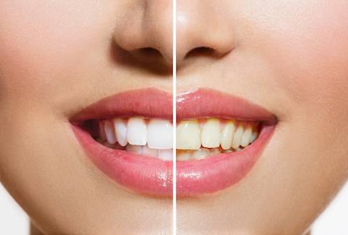 Before & After results of Teeth Whitening in Greeley, CO